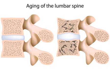 Aging Lumbar Spine